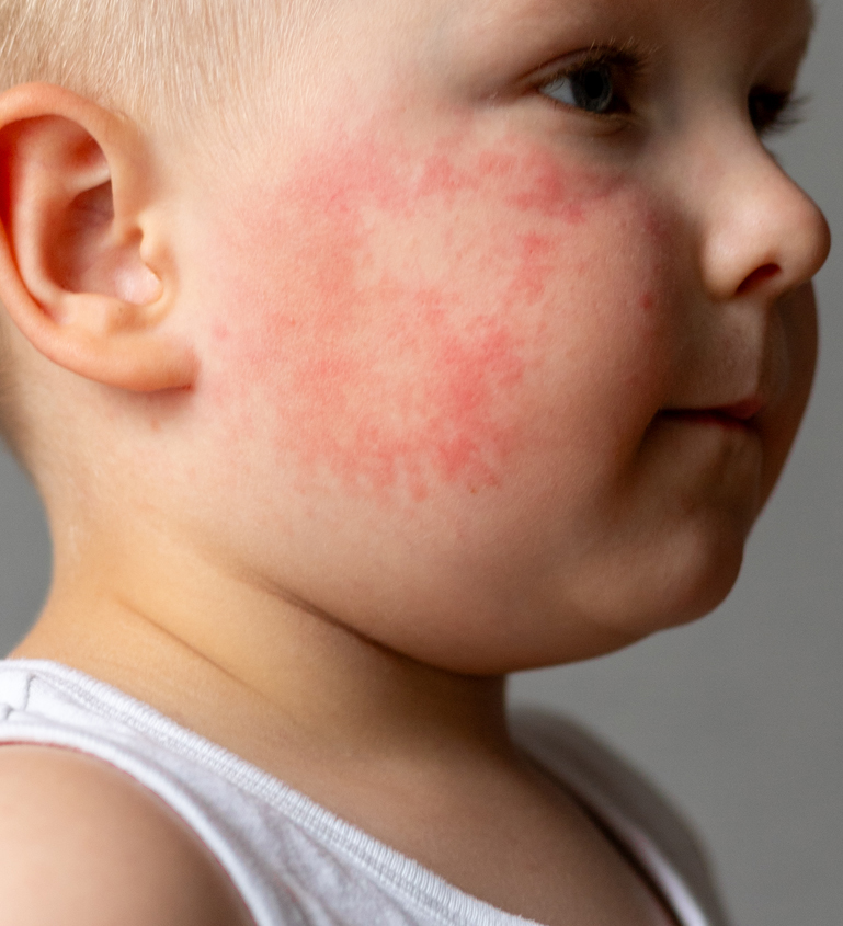 Impetigo Treatment