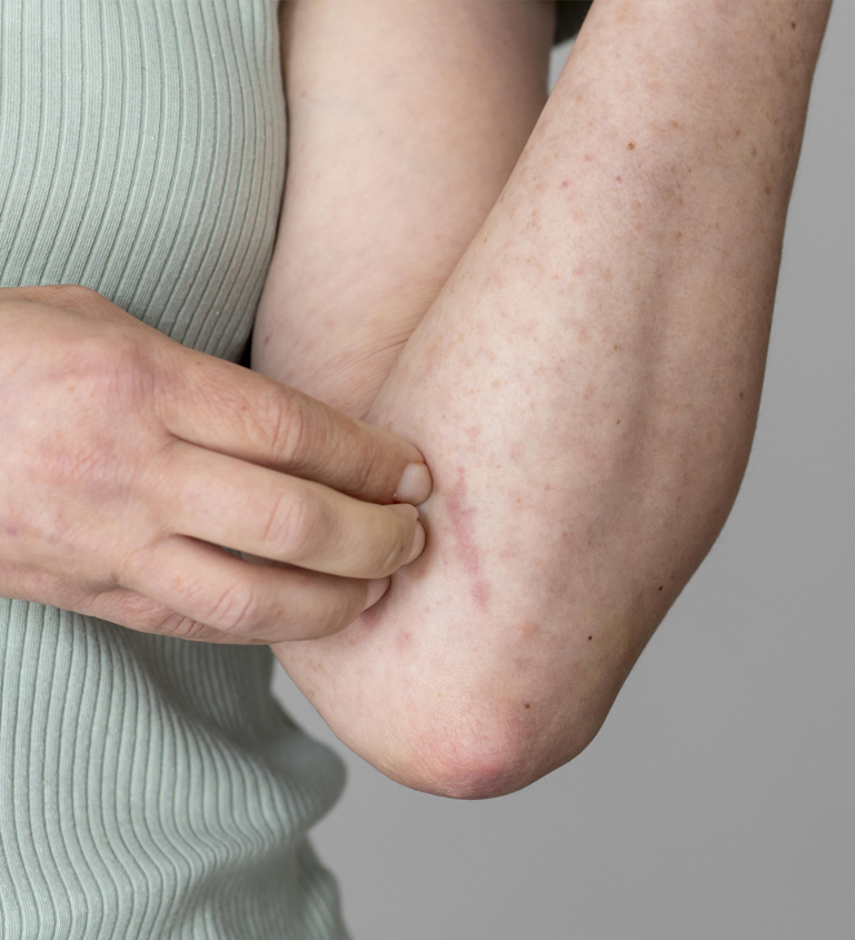 Insect Bite Treatment