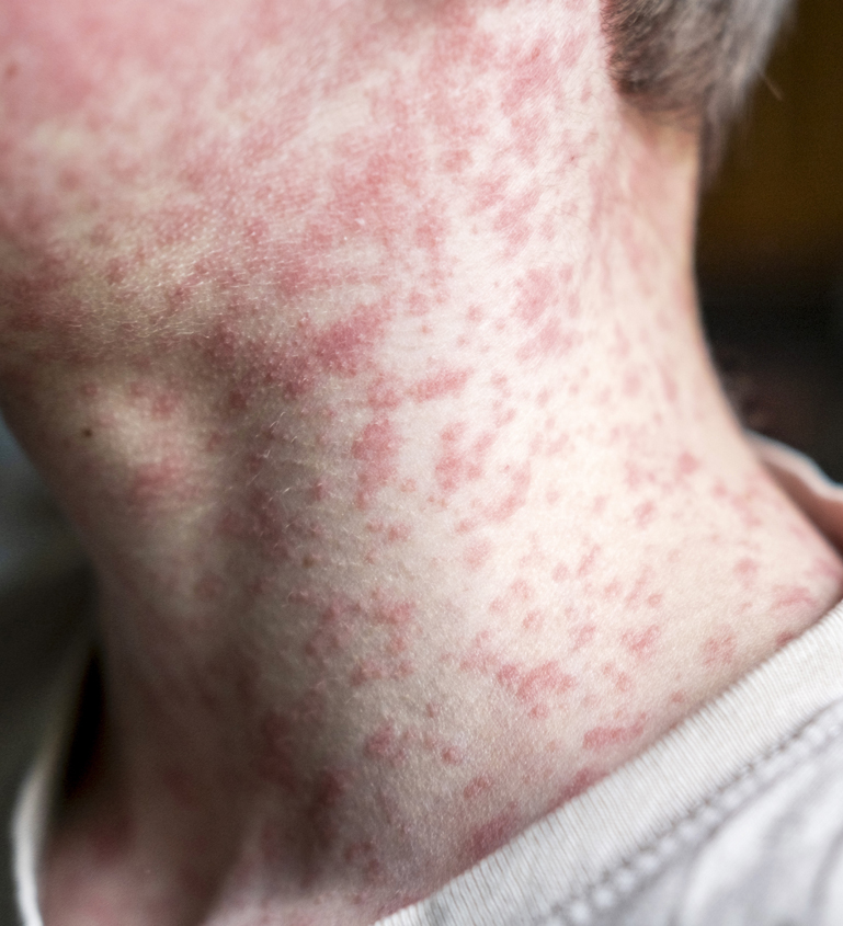 Shingles Treatment